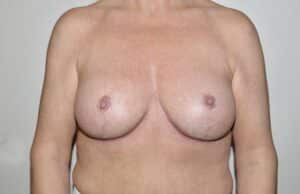 After Image: Breast Implant Removal with Lift