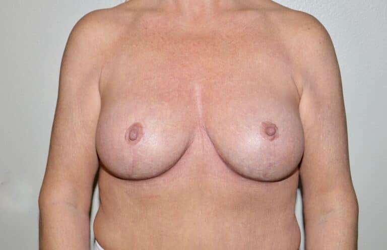 After Image: Breast Implant Removal with Lift - front