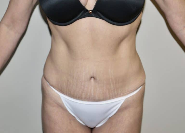 After Image: Abdominoplasty - front