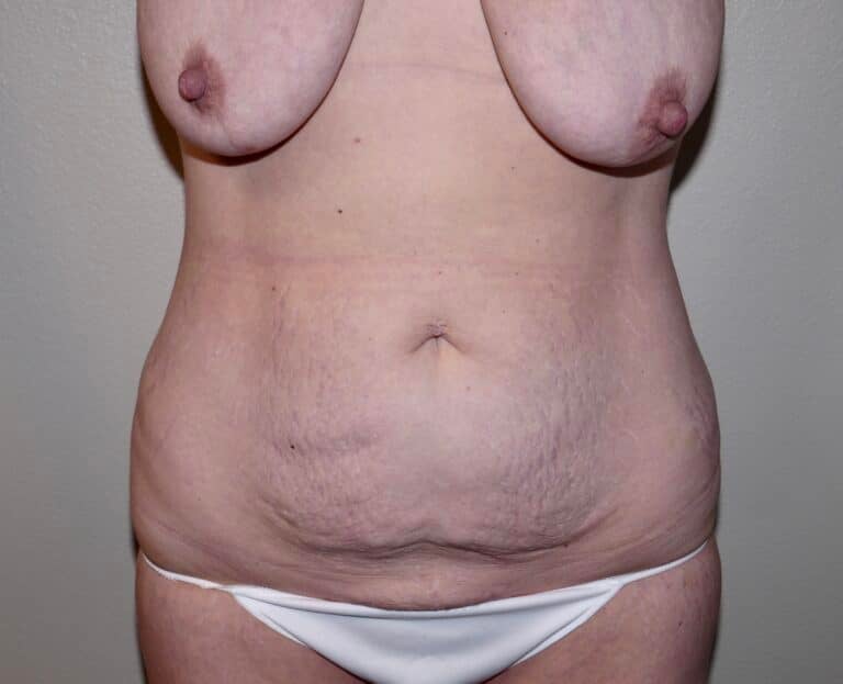 Before Image: Abdominoplasty -