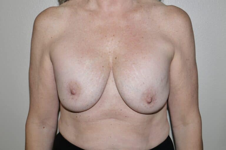 Before Image: Breast Implant Removal with Lift - front
