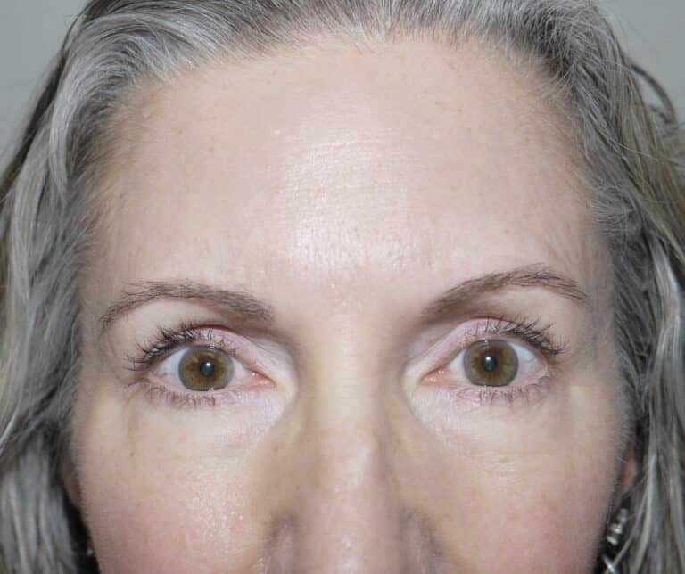 After Image: Blepharoplasty - front