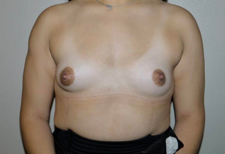 Before Image: Breast Augmentation - front