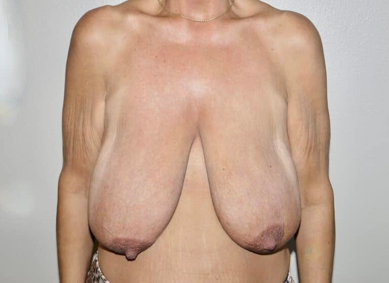 Before Image: Breast Reduction - front