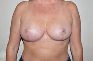 After Image: Breast Implant Removal with Lift