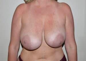 Before Image: Breast Implant Removal with Lift