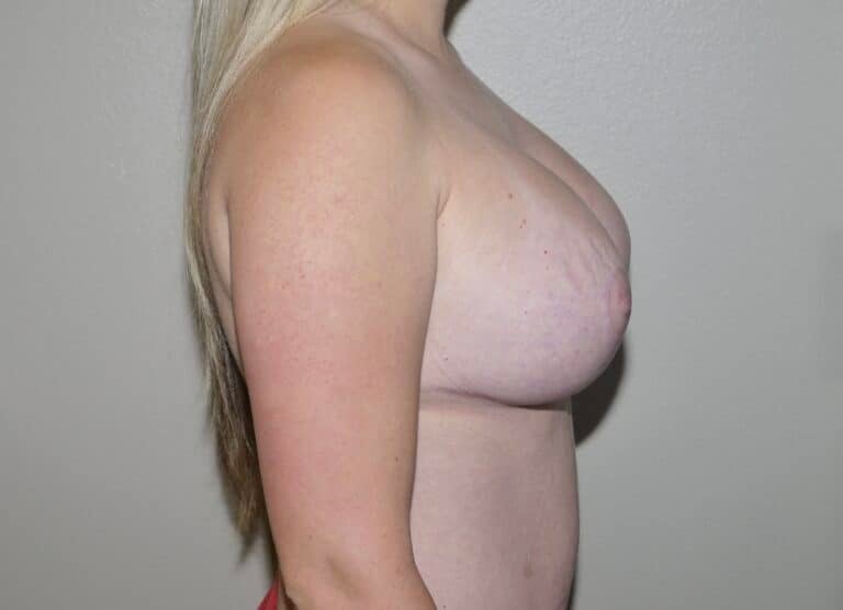 After Image: Breast Lift with Augmentation - right-side