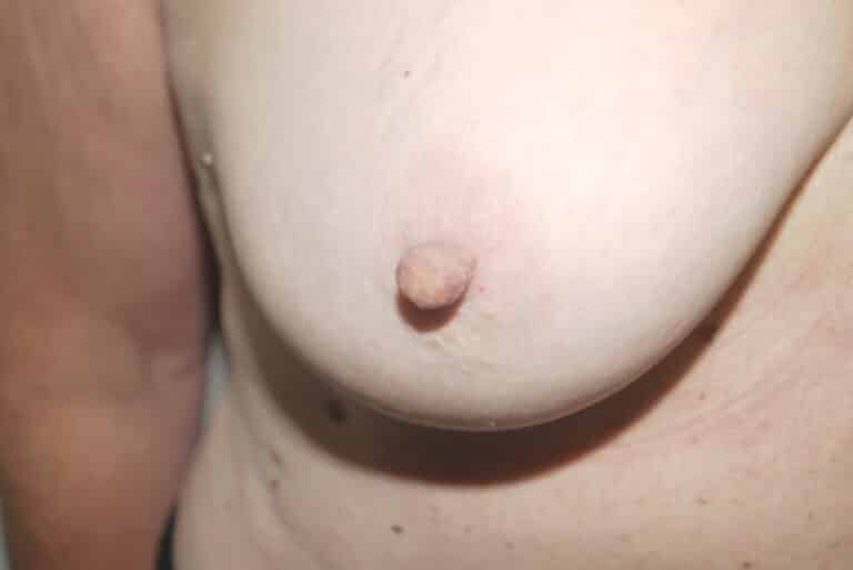 Before Image: Nipple Reduction - front