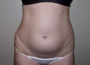 Before Image: Liposuction