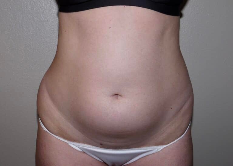 Before Image: Liposuction - front