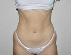 After Image: Liposuction
