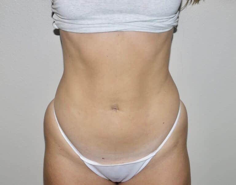 After Image: Liposuction - front