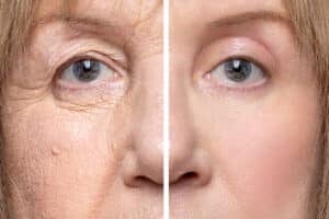Refreshed eyes after upper and lower eyelid surgery