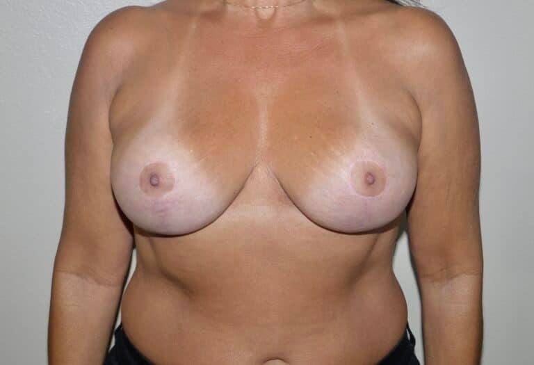 After Image: Breast Implant Removal with Lift - front